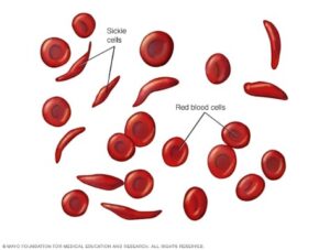 FAQ pregnancy and women's health - sickle cell anemia